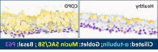 Oxidise IL-33 may be a driver of the mucus overproduction in COPD3